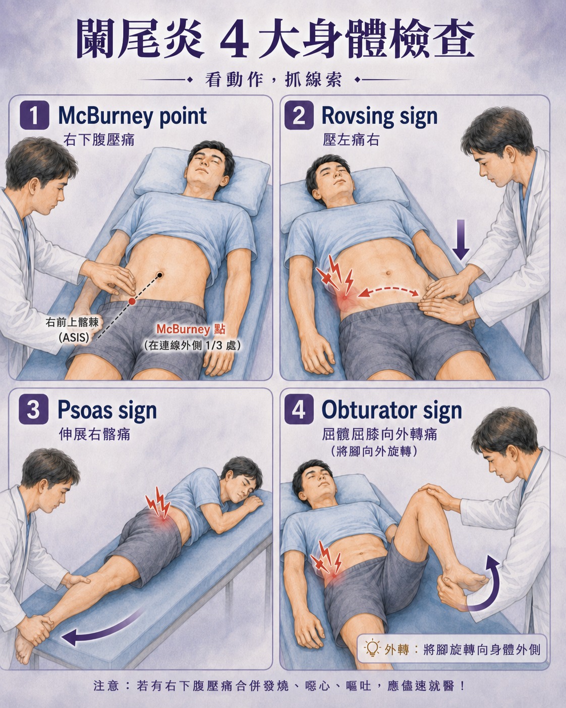 McBurney point、Rovsing、psoas 與 obturator signs 四種闌尾炎理學檢查示意圖